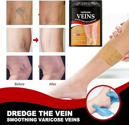 Varicose Veins Treatment Patch,12 PCS